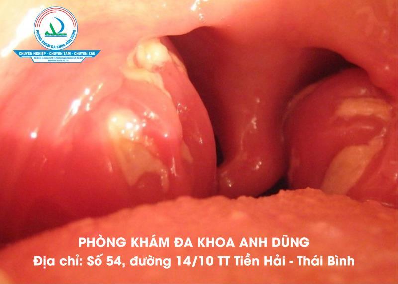 Áp xe quanh Amidan: Dấu hiệu nhận biết và cách điều trị